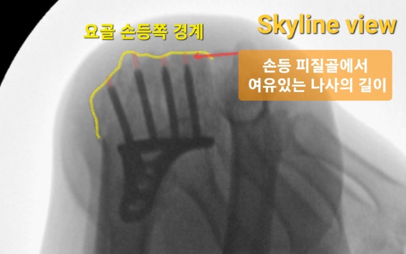 원위요골골절 (Distal radius fracture)의 수술 시기 : 부기가 생기기 전에 빠른 수술, 좋은 결과 : 네이버 블로그
