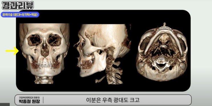  남자윤곽3종 3d ct 분석 - 사각턱, 턱끝 광대 수술