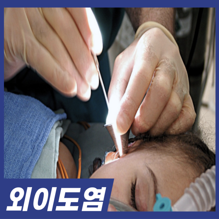  귀에 물찬 느낌 들때? 외이도염 증상 원인 예방법
