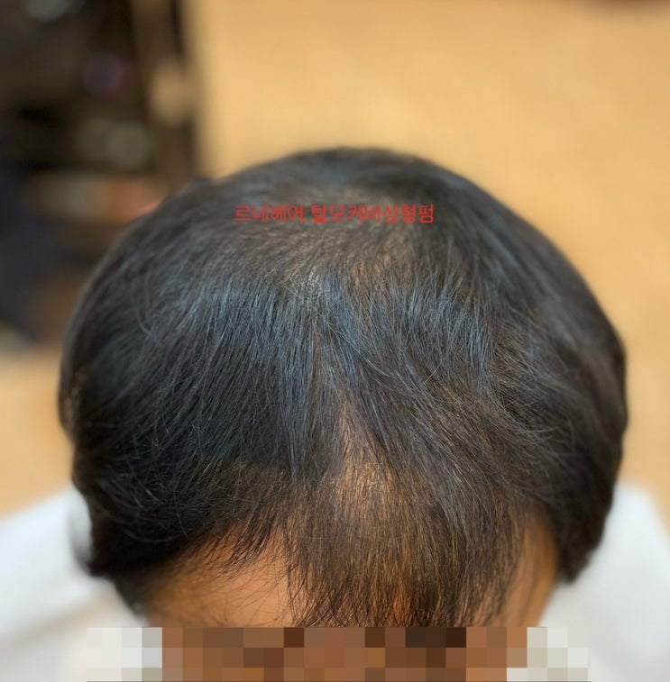  남자M자 정수리탈모시술후 부산사상구 르네헤어/ 감전모라만덕덕천화명동래명륜사직금정안락충렬연제연산거제리하마정양정수영망미해운대남천진구개금구덕남포초량거제울산양산남해용원가덕대저김해창원진주