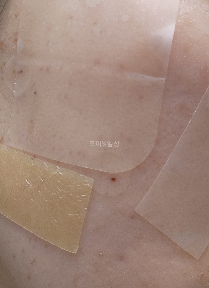  [결혼준비]편평사마귀 제거/실비/후기, 어붐야그 레이져 관리 방법,4~8일차 사진