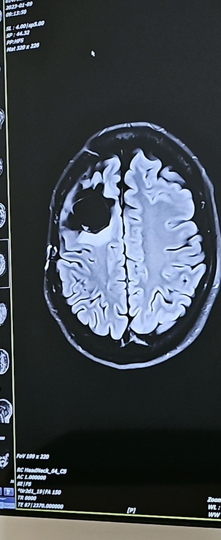  뇌종양 3기 뇌MRI 검사 (수술4년차) 후기 [역형상 성상세포종]