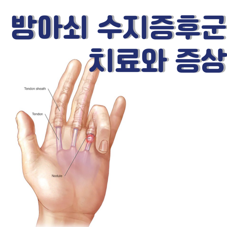  방아쇠수지증후군 치료 증상, 손가락 마디 통증이 나타난다.