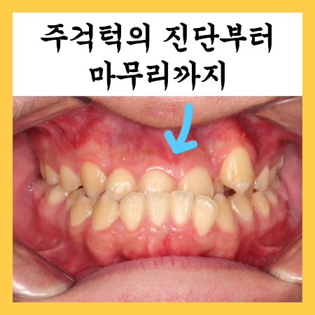  중계동 치아교정, 주걱턱의 진단부터 마무리까지