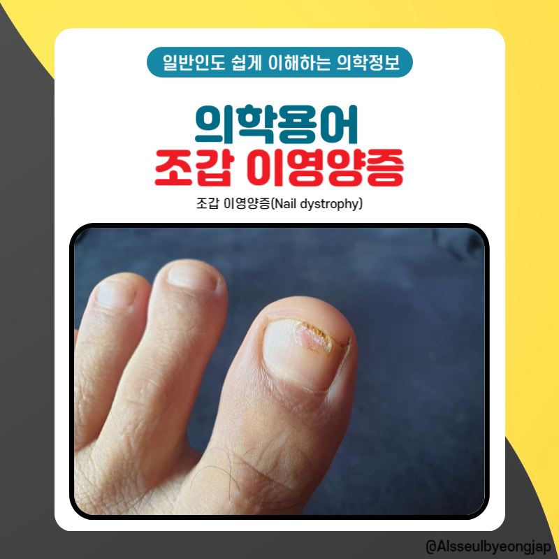 조갑 이영양증 손발톱이 얇아지고 깨진다면?