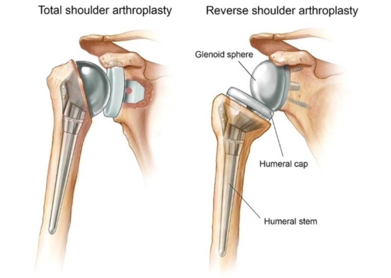 역행성 어깨 관절치환술 (RTSA, Reverse Total Shoulder Arthroplasty) : 네이버 블로그