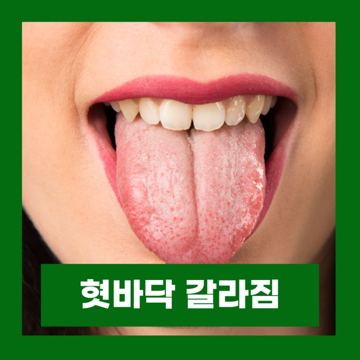  혓바닥 갈라짐 원인 및 치료 혀 가운데 갈라짐 통증 건강상태