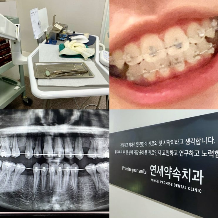 운정 연세 약속 치과 : 발치 치아 교정 5개월차가 느낀 장단점