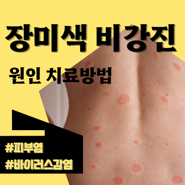  장미색비강진 원인 증상 치료방법