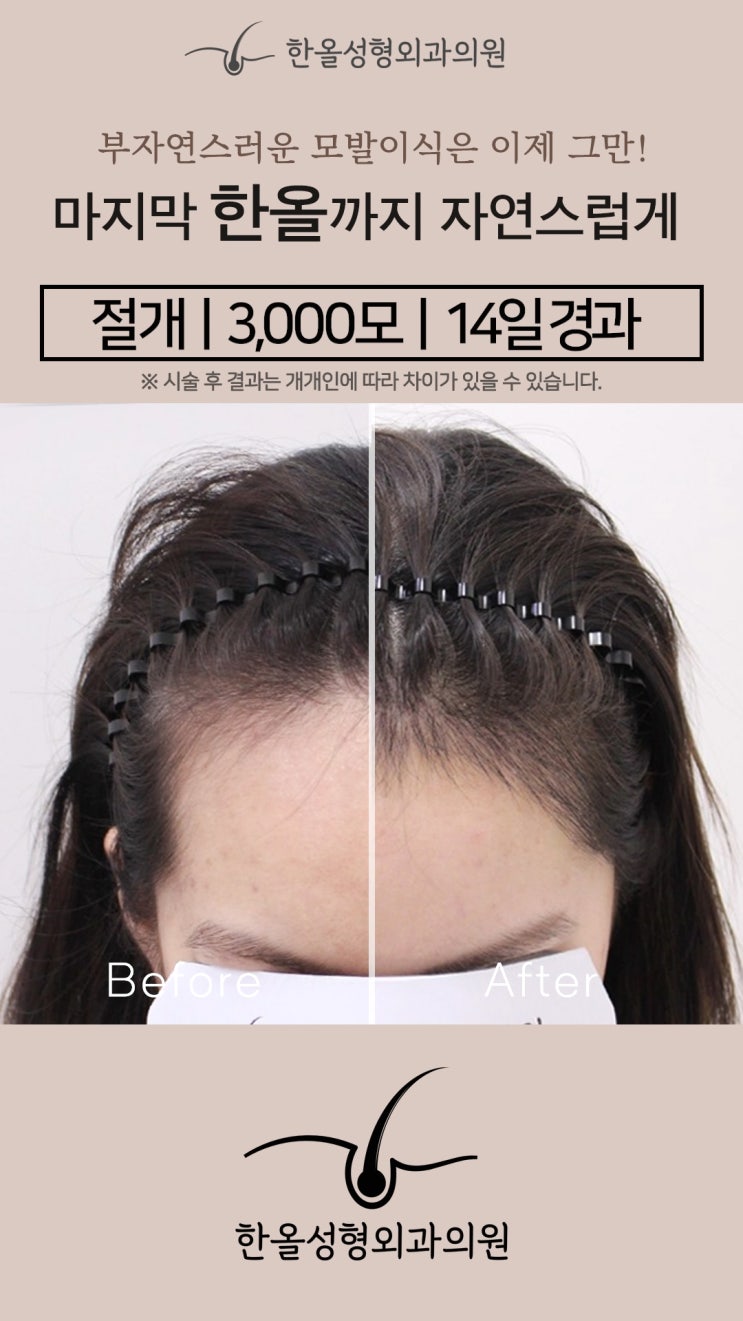  [한올성형외과] 절개 모발이식 3000모 14일 경과 - 모발이식 비용/모발이식생착률/절개모발이식/비절개모발이식/모발이식 후기