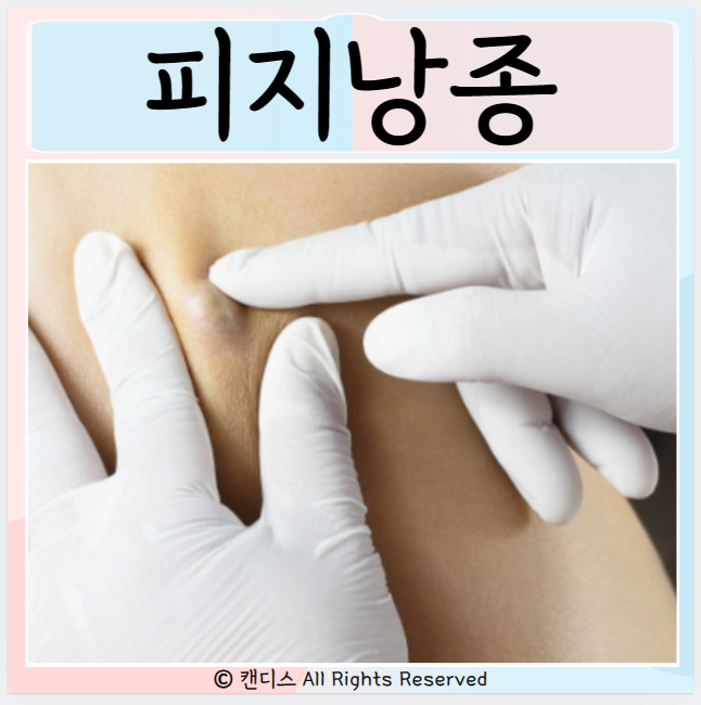  피지낭종 원인 피부손상 증상 치료 수술