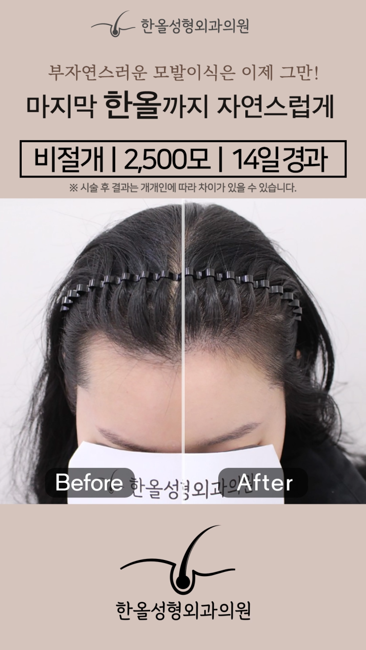  [한올성형외과] 비절개모발이식 2500모 14일 경과 - 모발이식 비용  ㅣ헤어라인 모발이식ㅣ모발이식 생착률ㅣ모발이식 가격ㅣ모발이식 후기