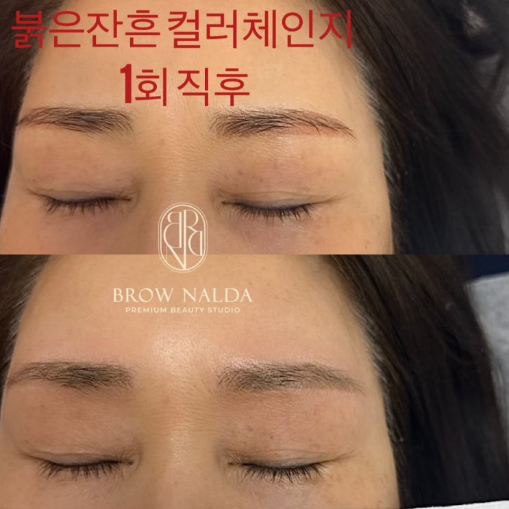  탑동눈썹문신후 붉은 기가 더 심해졌다면?