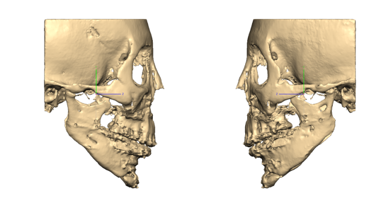 3D 안면골 사각턱 재건 복원에서 환자맞춤형보형물을 정확하게 위치시키는 법