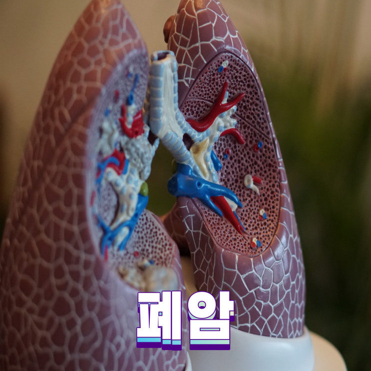  폐암 초기증상 원인 흡연 흉통
