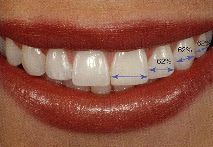 치아교정학에서 얘기하는 미시적 심미 (Micro-esthetics) : 치아 크기 비율과 조화