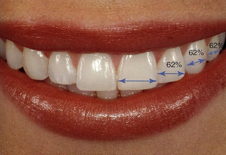  치아교정학에서 얘기하는 미시적 심미 (Micro-esthetics) : 치아 크기 비율과 조화