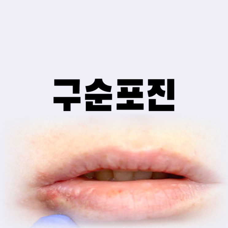 구순포진 원인 증상 전염 막는 치료 약 연고까지