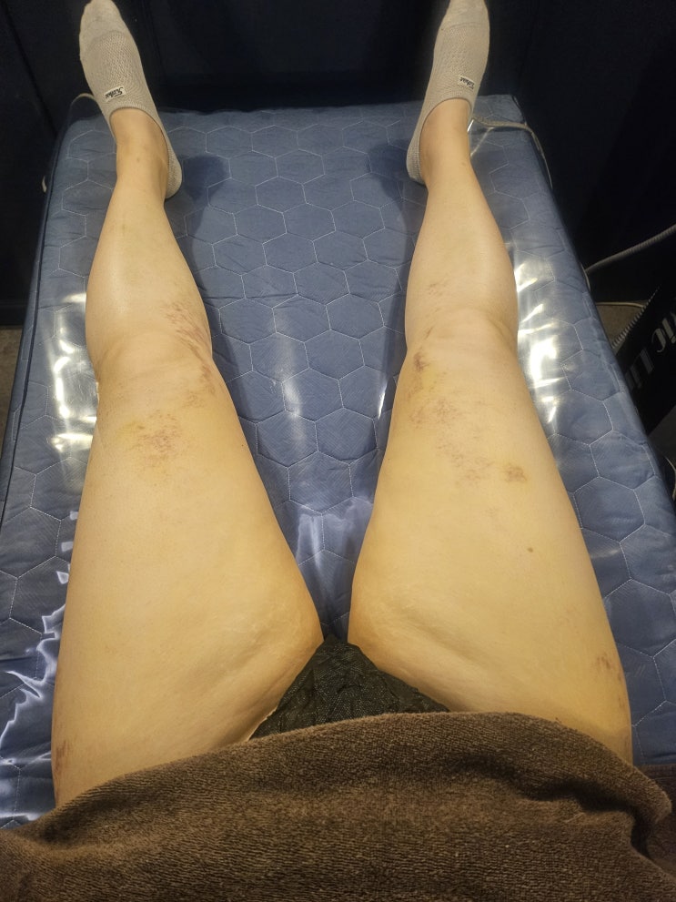  하체 지방흡입 바본 여러분의 다리가 더 두꺼워진 이유는?