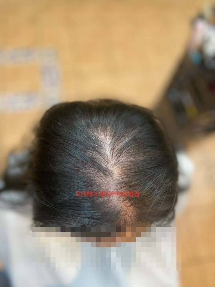  여성탈모 펌 모류 교정 복구 케 변신 후/부산  감전개금김해주례학장만덕덕천화명명지다대녹산용원당감서면전포부전양정연제하마정거제리사직남천용원대연광안수영망미토곡안락해운대정관가야동래금정장전