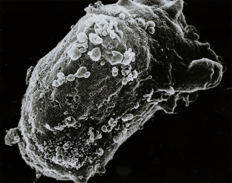  LYMPHOCYTE 수치 림프구 수치 증가 감소