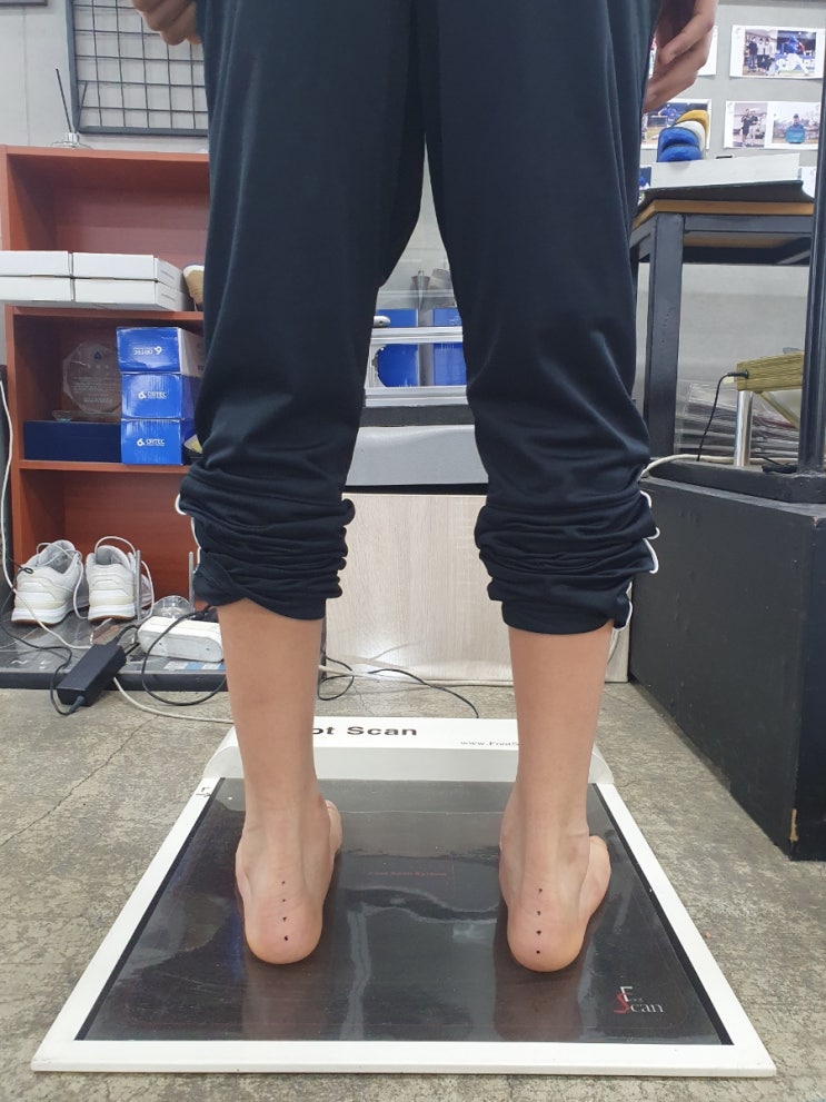  운동선수의 발 통증, 무릎 통증, 무시하고 가볍게 넘어가면 안 되는 이유 (대구 맞춤 깔창 제작 전문)