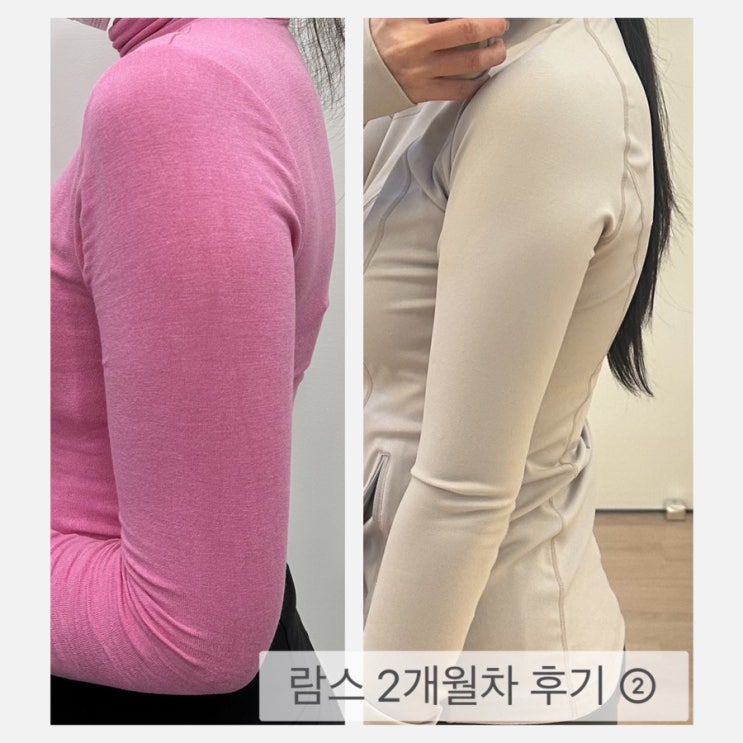  천안지방추출주사 팔뚝부위 2개월차후기② 2개월간의 놀라운변화