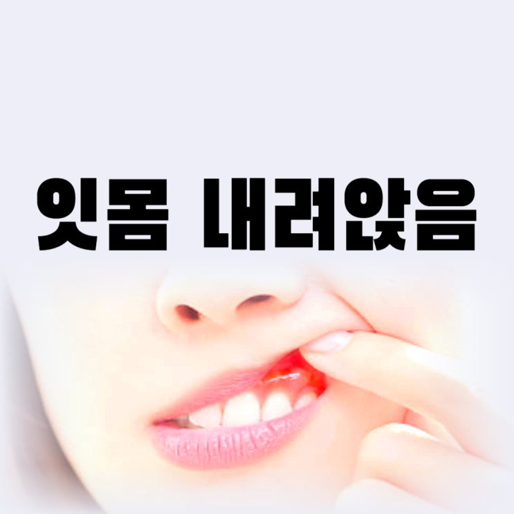  잇몸 내려앉음 원인 치료 약 잇몸 내려앉은 시림 증상 예방법은