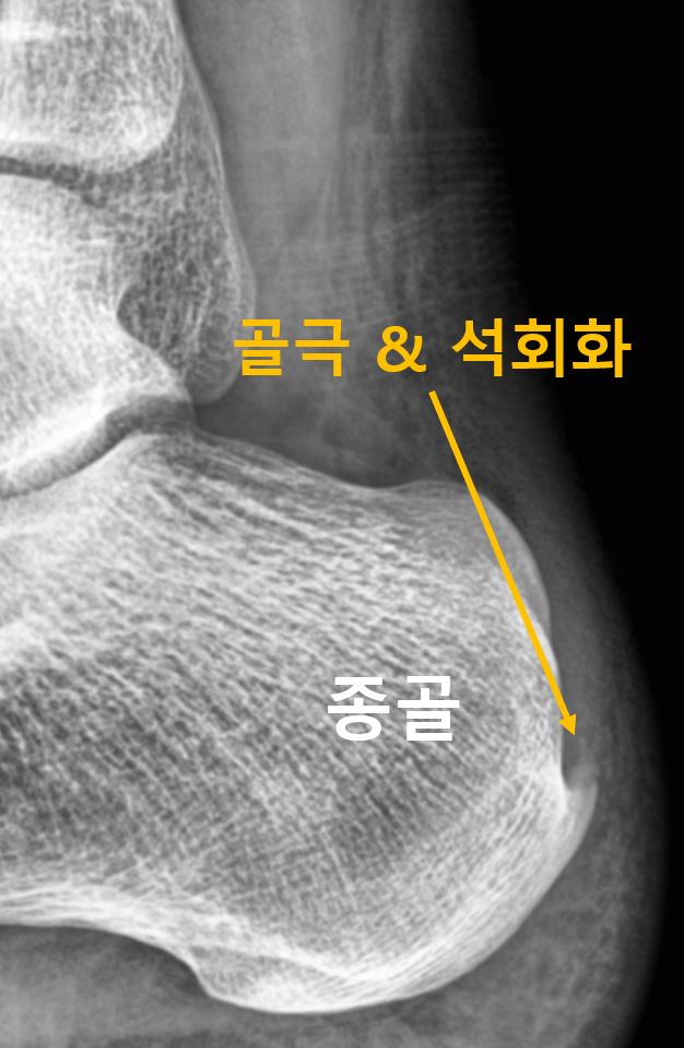  광주 아킬레스건염, 치료받아도 걷는 게 두려워요