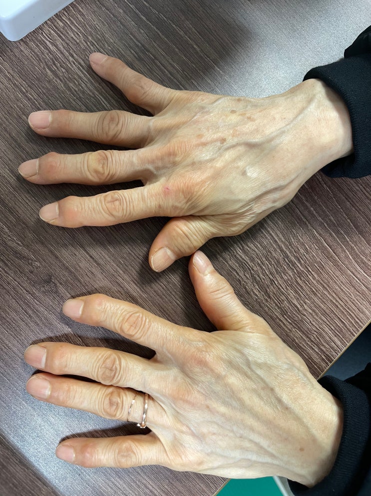  손가락 마디통증  손가락 관절염 손가락 통증