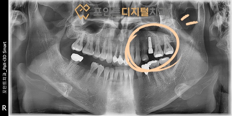  [탕정역치과] 치아파절로 발치(발치즉시 임플란트) / 천안 아산