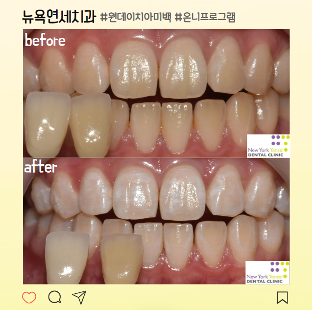  강남역치아미백으로 깔끔한 미소를
