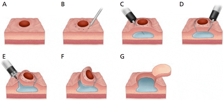  Gastric adenoma, Gastric tumor