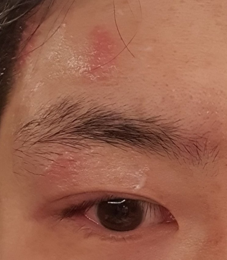  얼굴 대상포진 초기 증상부터 4일차 후기 일지 흉터관리