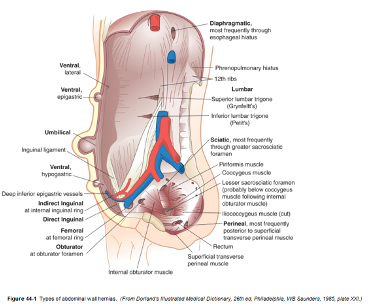  Inguinal hernia 분류와 수술방법(TEP, TAPP) 비교