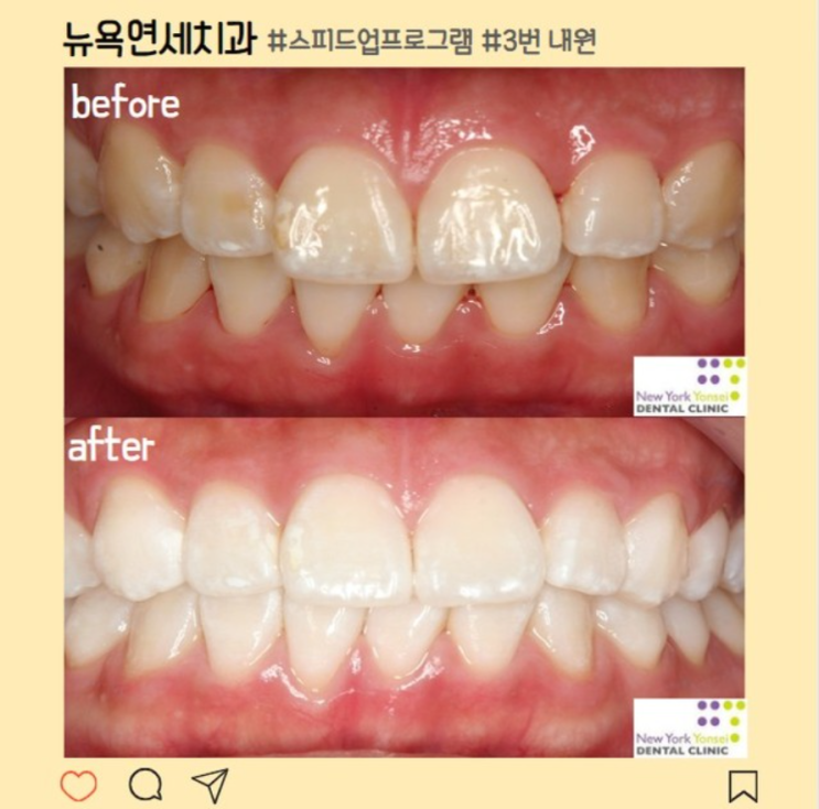  강남치아미백 안전하고 효과 좋은 치과를 찾고 있다면?