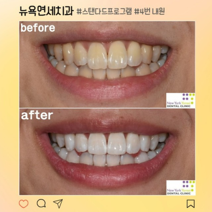  강남역치아미백 확실한 효과를 원한다면