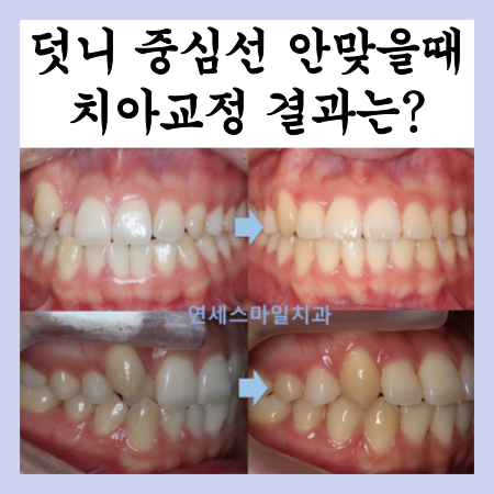  덧니 치아교정, 중심선이 맞지 않을때 (중랑구 교정치과)