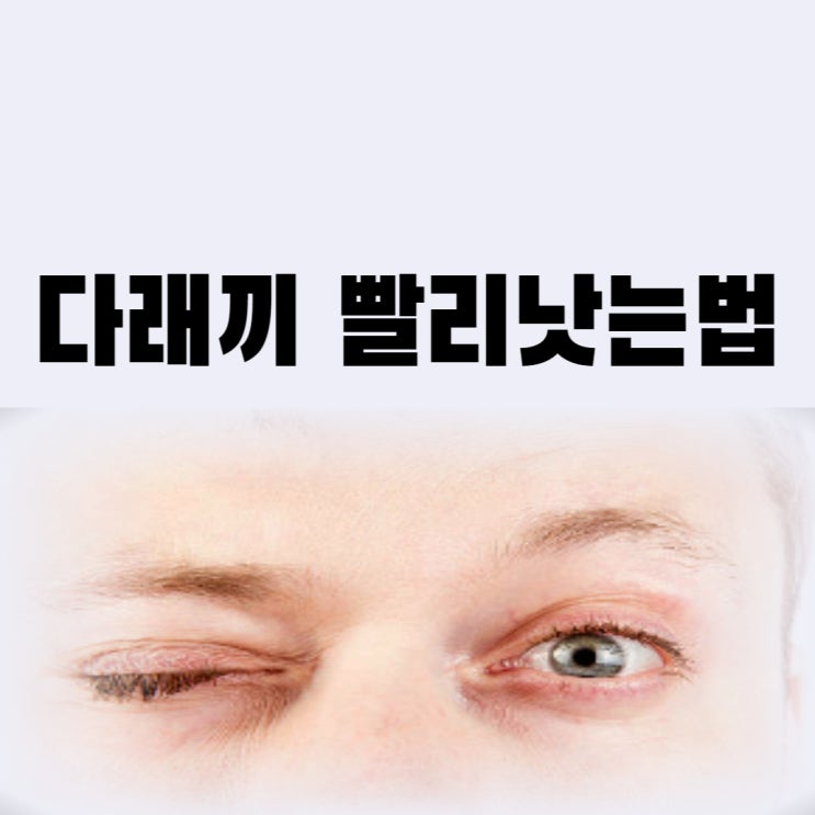  속 다래끼빨리낫는법(겉, 콩, 눈) 치료 늦으면 다래끼 전염될까