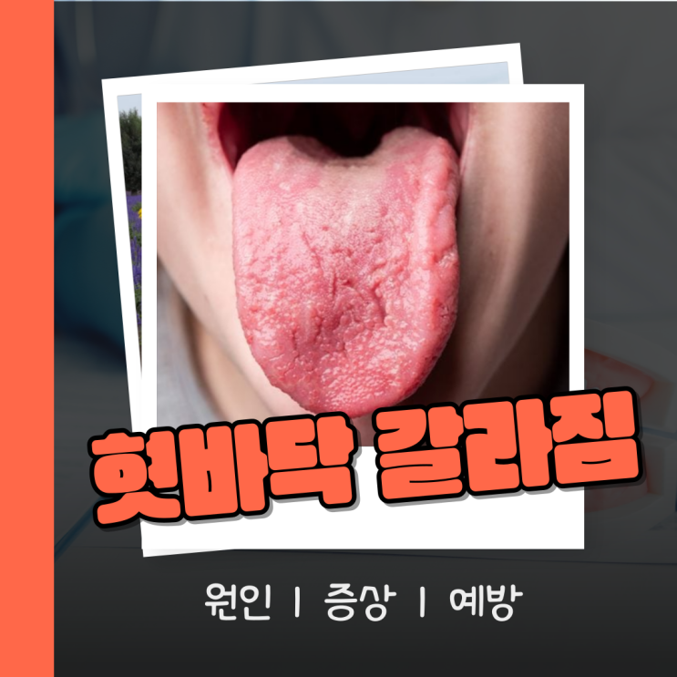  혓바닥 갈라짐 원인 증상 예방