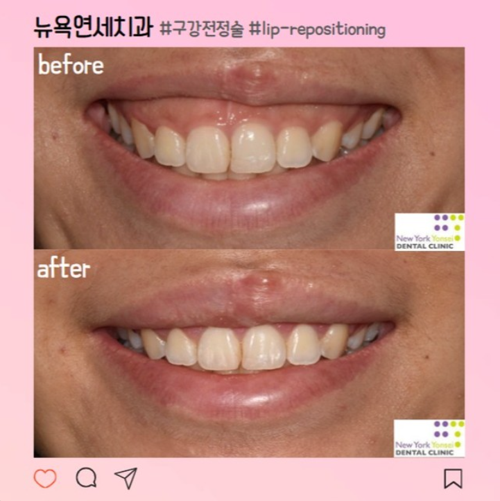  웃을 때 과한 잇몸? 강남 뉴욕연세 치과 구강전정술로 해결!