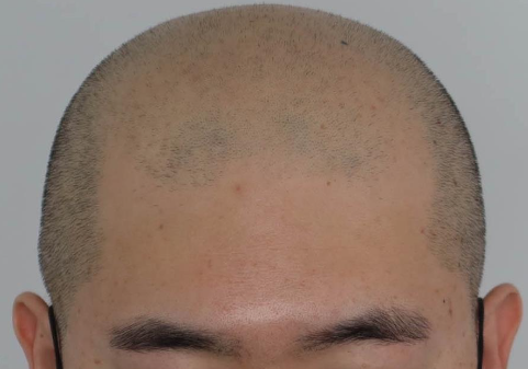  탈모예방 하는 방법 두피관리 부터 해보자