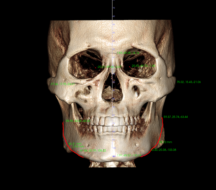 3D CT를 이용한 안면윤곽 사각턱 수술 절제 위치에 따른 얼굴폭 축소량 조절(1) - 남성윤곽 사각턱 부작용 예방 술전 신경관확인