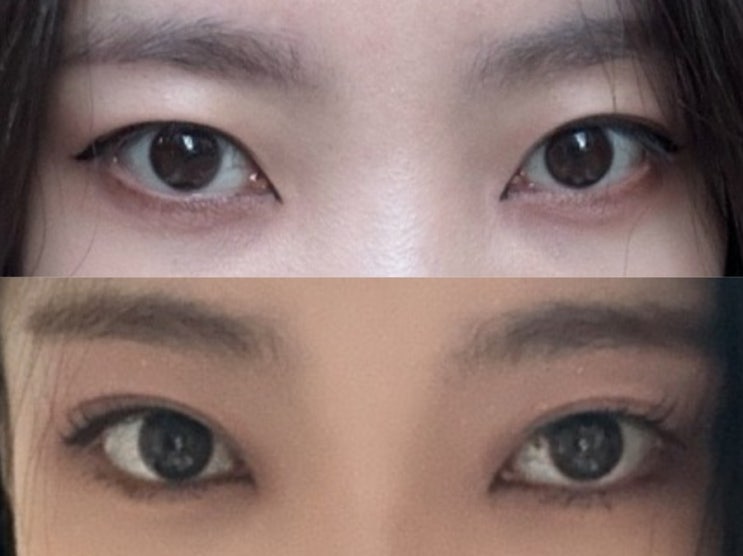  대구 플라즈마 쌍꺼풀 탄력과 눈꺼짐 주름 쌍꺼풀라인 바뀐 직후 (상안검)부작용 없이 예뻐지는 방법!