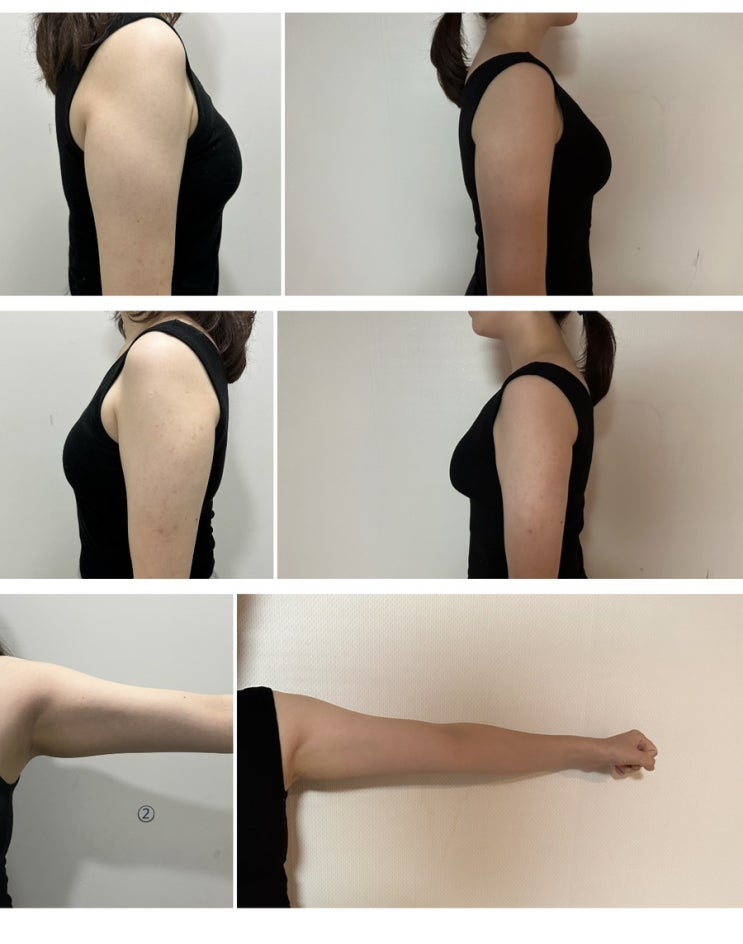  서면피부과 다이어트 바디핏주사 팔뚝 맞은 7일차 후기