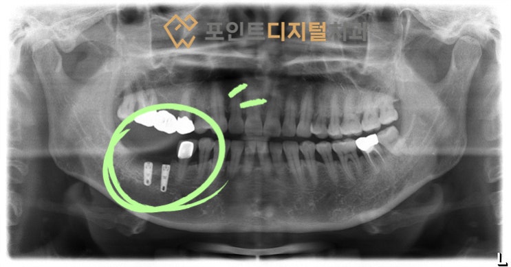  [탕정치과] 임플란트 14년 경과(짐머TSV) / 천안 아산