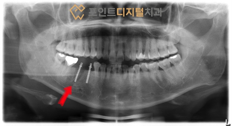  [탕정치과] 임플란트 15년 경과(발치즉시 임플란트, 짐머TSV) + 임플란트 보철물 파절 / 천안 아산