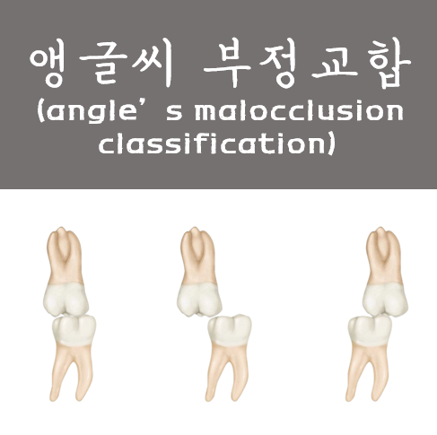 앵글씨 부정교합(angle's malocclusion classification)