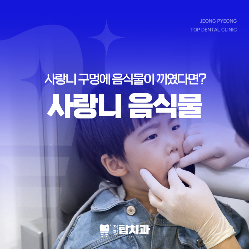 사랑니 구멍 음식물 끼이면 이렇게 대처