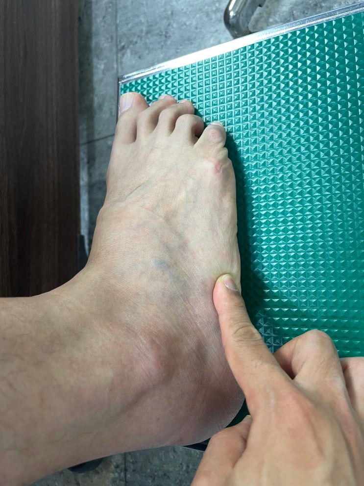  발날 통증 , 발외측 통증, 비골건부착부 염증 치료 꿀팁